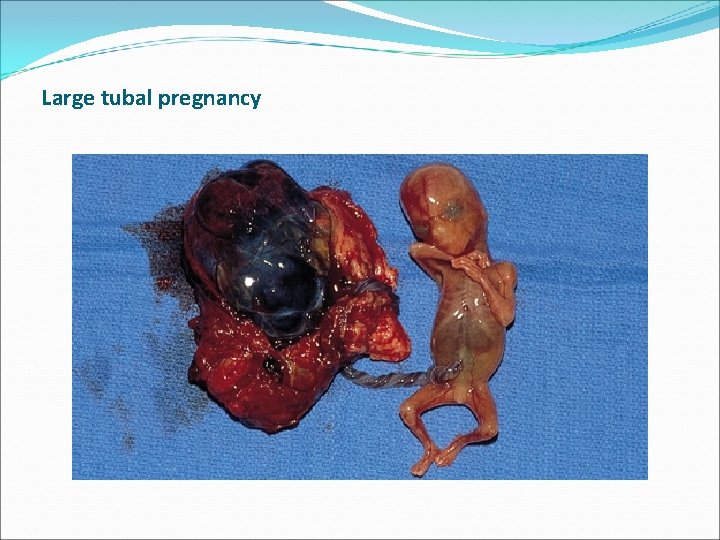 Large tubal pregnancy Large tubal pregnancy