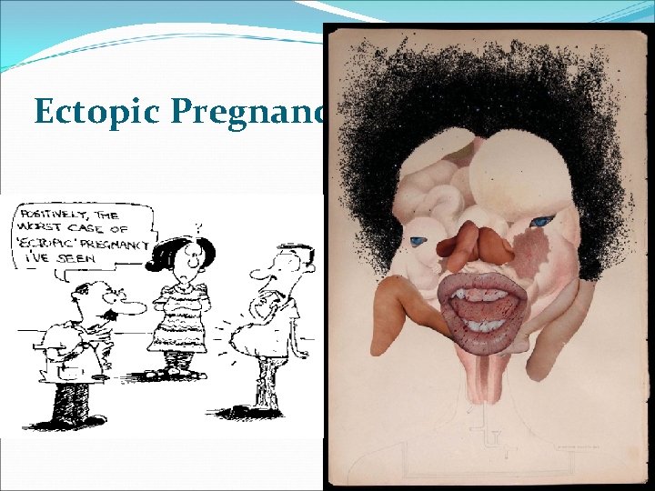 Ectopic Pregnancy Ectopic Pregnancy