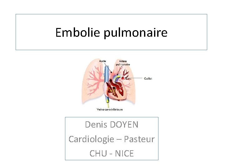 Embolie pulmonaire Denis DOYEN Cardiologie – Pasteur CHU - NICE 