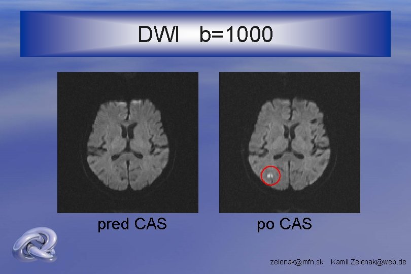 DWI b=1000 pred CAS po CAS zelenak@mfn. sk Kamil. Zelenak@web. de 