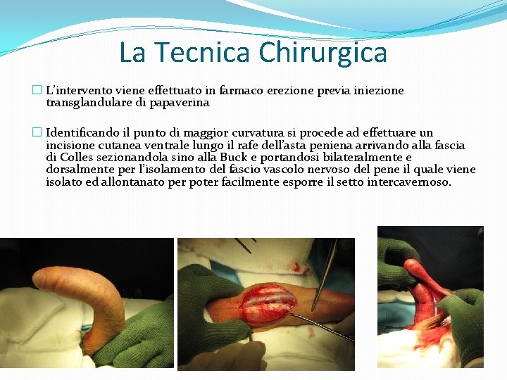 La Tecnica Chirurgica � L’intervento viene effettuato in farmaco erezione previa iniezione transglandulare di