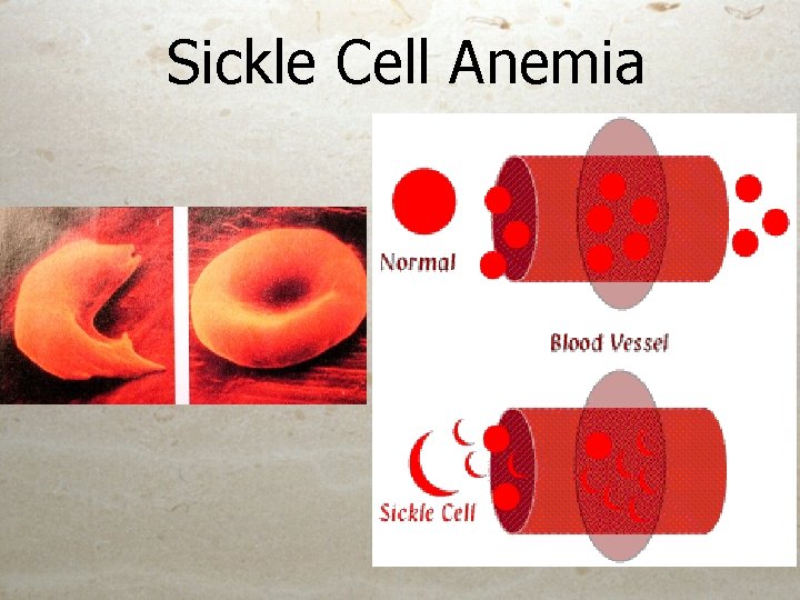 Sickle Cell Anemia Sickle Cell Anemia