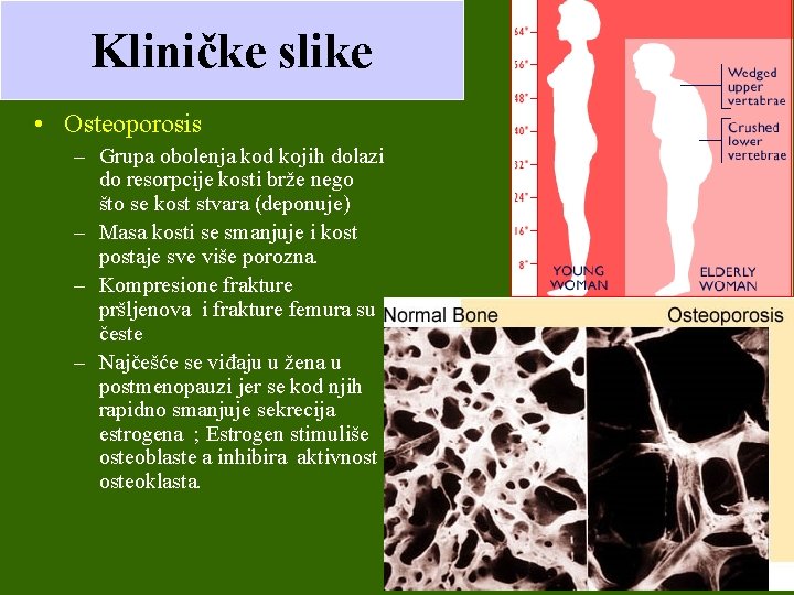 Kliničke slike • Osteoporosis – Grupa obolenja kod kojih dolazi do resorpcije kosti brže