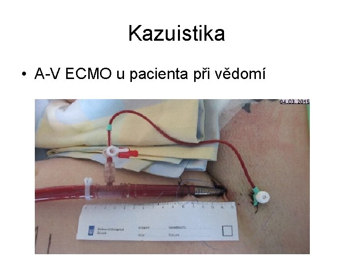 Kazuistika • A-V ECMO u pacienta při vědomí 