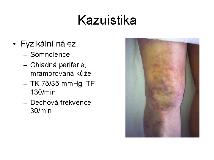 Kazuistika • Fyzikální nález – Somnolence – Chladná periferie, mramorovaná kůže – TK 75/35