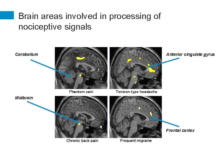 Brain areas involved in processing of nociceptive signals Cerebellum Anterior cingulate gyrus Midbrain Frontal