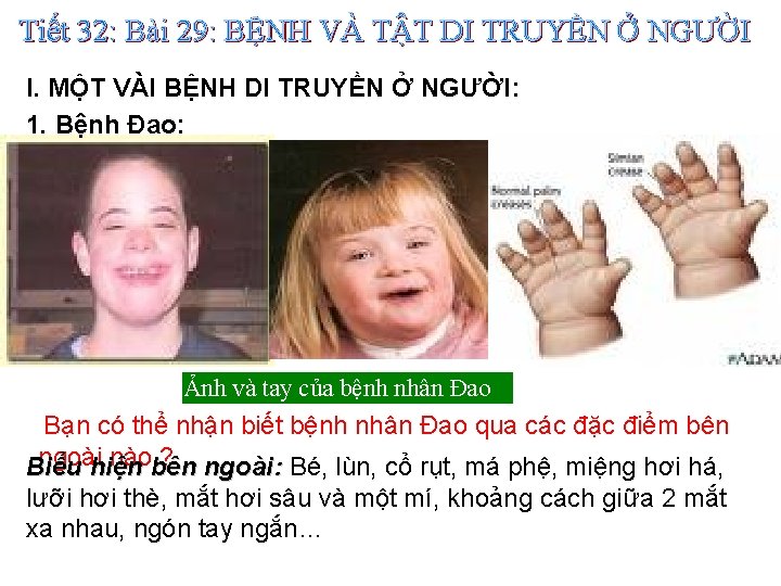 Tiết 32: Bài 29: BỆNH VÀ TẬT DI TRUYỀN Ở NGƯỜI I. MỘT VÀI