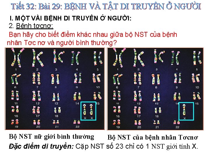 Tiết 32: Bài 29: BỆNH VÀ TẬT DI TRUYỀN Ở NGƯỜI I. MỘT VÀI