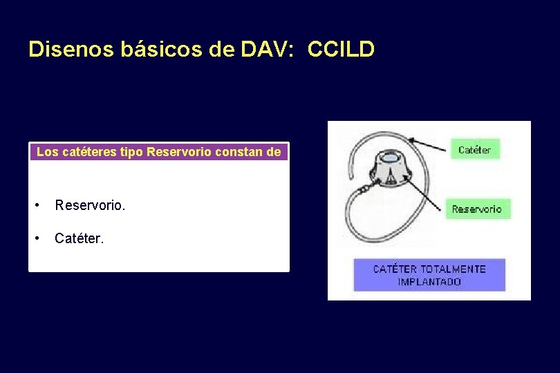 Disenos básicos de DAV: CCILD Los catéteres tipo Reservorio constan de • Reservorio. •