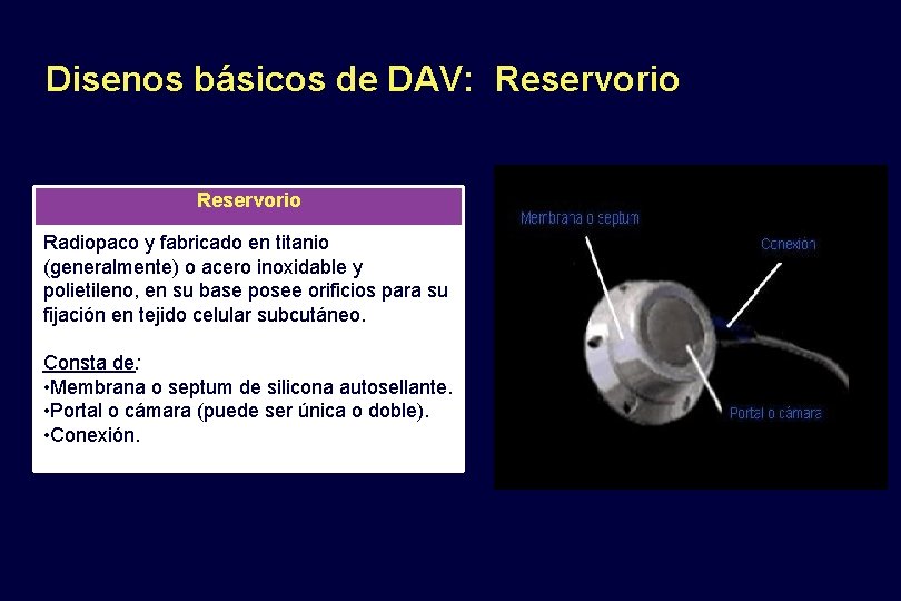 Disenos básicos de DAV: Reservorio Radiopaco y fabricado en titanio (generalmente) o acero inoxidable