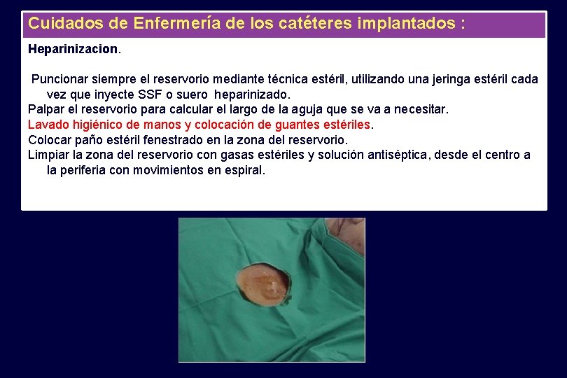 Cuidados de Enfermería de los catéteres implantados : Heparinizacion. Puncionar siempre el reservorio mediante