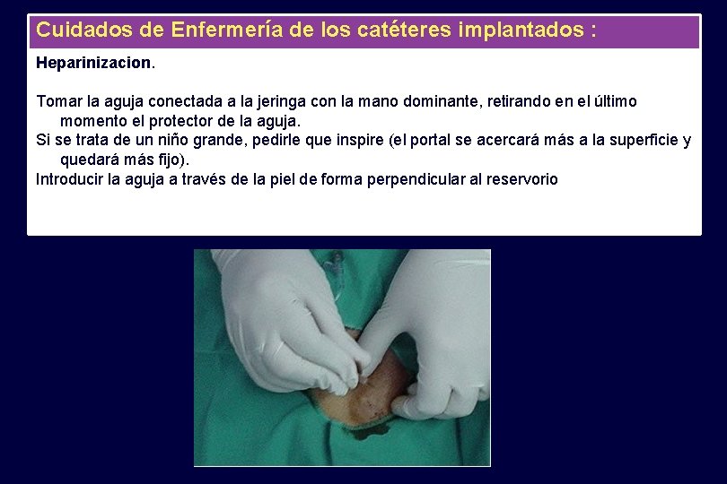 Cuidados de Enfermería de los catéteres implantados : Heparinizacion. Tomar la aguja conectada a