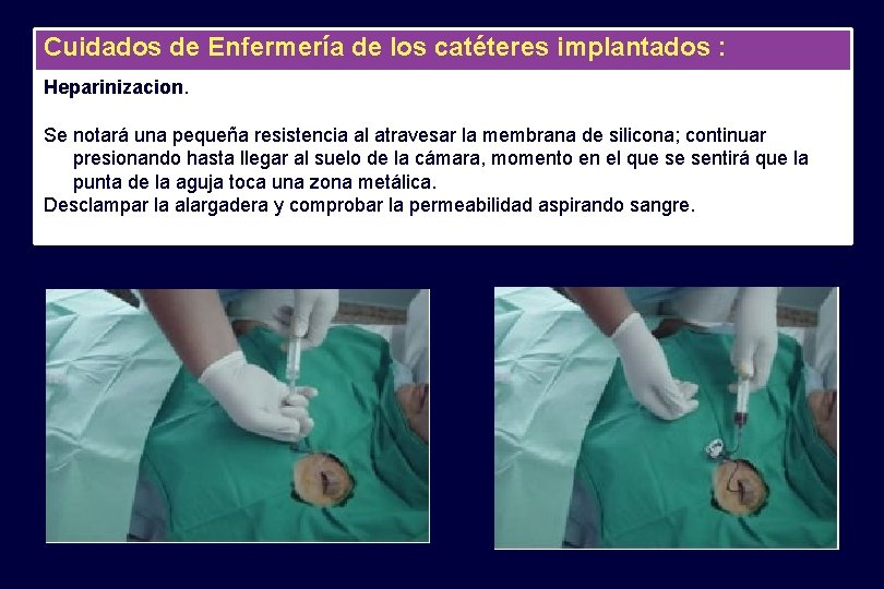 Cuidados de Enfermería de los catéteres implantados : Heparinizacion. Se notará una pequeña resistencia