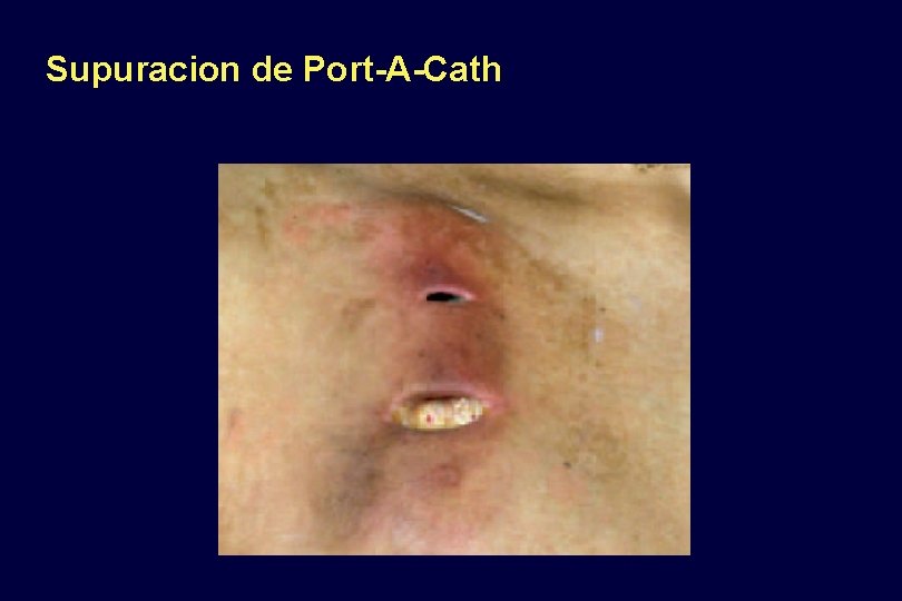 Supuracion de Port-A-Cath 