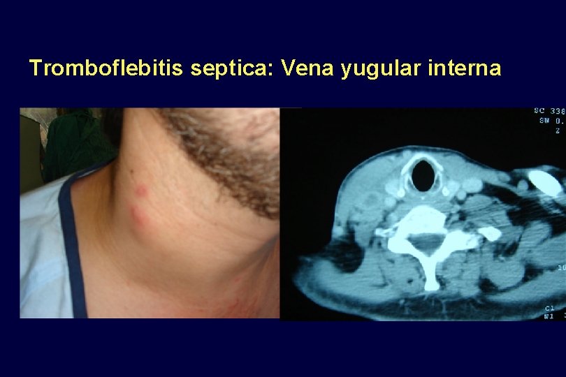 Tromboflebitis septica: Vena yugular interna 