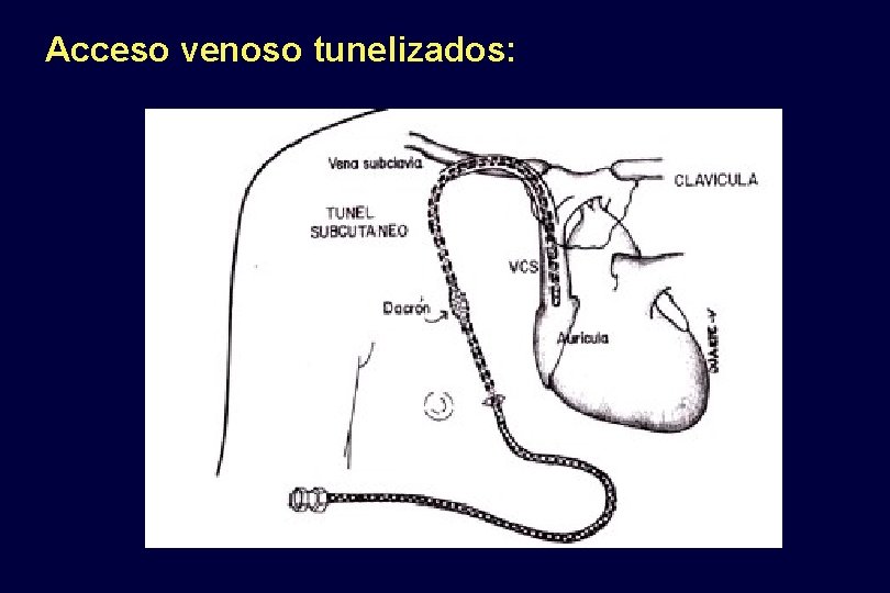 Acceso venoso tunelizados: 