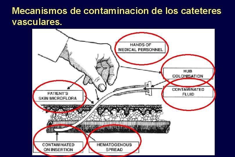 Mecanismos de contaminacion de los cateteres vasculares. 