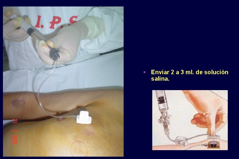 § Enviar 2 a 3 ml. de solución salina. 