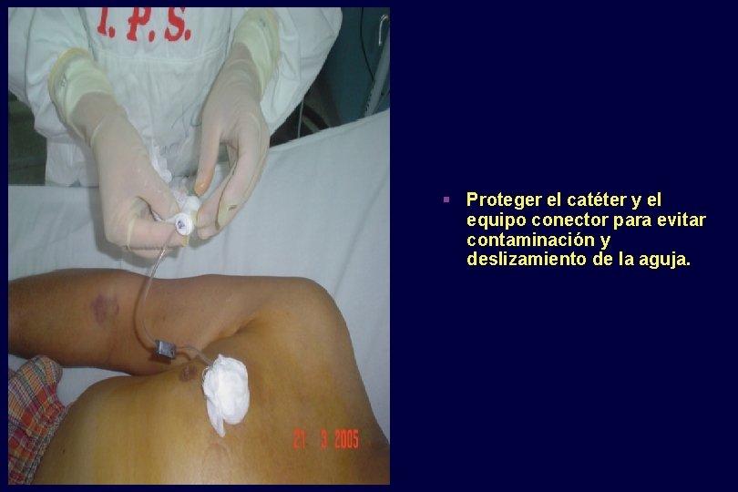 § Proteger el catéter y el equipo conector para evitar contaminación y deslizamiento de