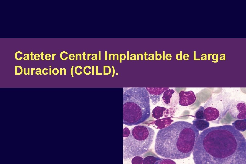 Cateter Central Implantable de Larga Duracion (CCILD). 