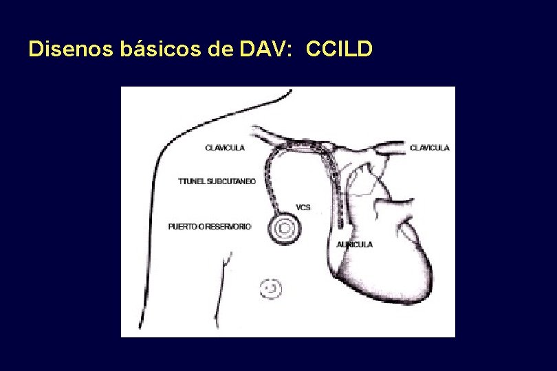 Disenos básicos de DAV: CCILD 