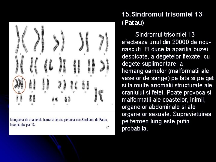 15. Sindromul trisomiei 13 (Patau) Sindromul trisomiei 13 afecteaza unul din 20000 de nounascuti.