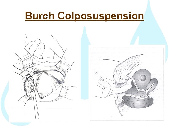 Burch Colposuspension 