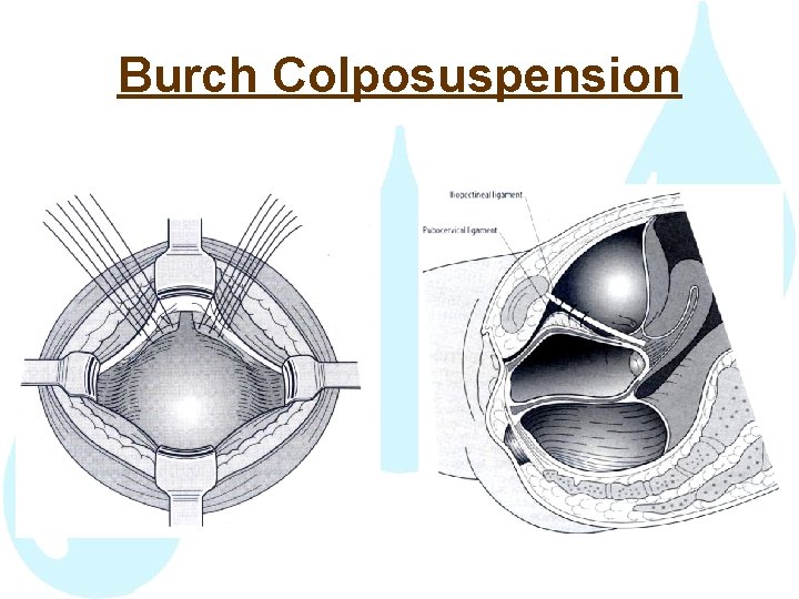 Burch Colposuspension 