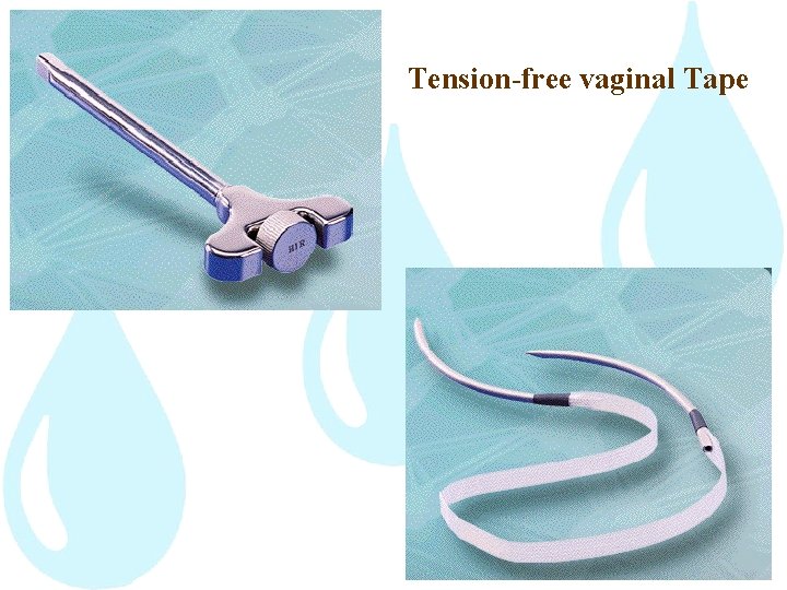 Tension-free vaginal Tape 