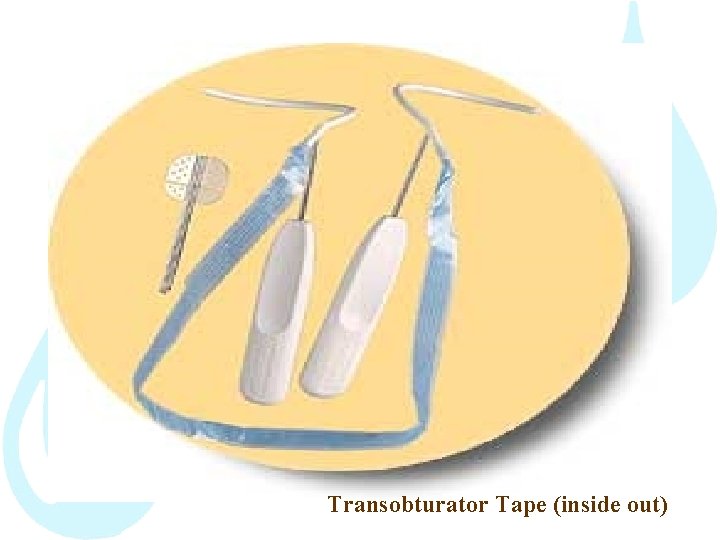 Transobturator Tape (inside out) 