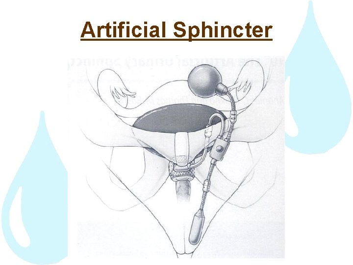 Artificial Sphincter 
