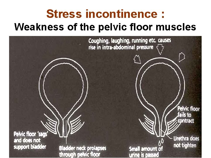 Stress incontinence : Weakness of the pelvic floor muscles 