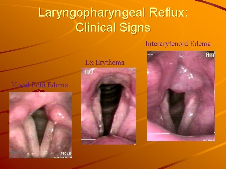 Laryngopharyngeal Reflux: Clinical Signs Interarytenoid Edema Lx Erythema Vocal Fold Edema 