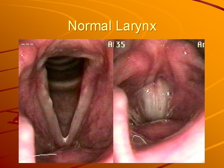 Normal Larynx 