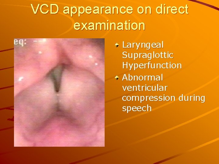 VCD appearance on direct examination Laryngeal Supraglottic Hyperfunction Abnormal ventricular compression during speech 