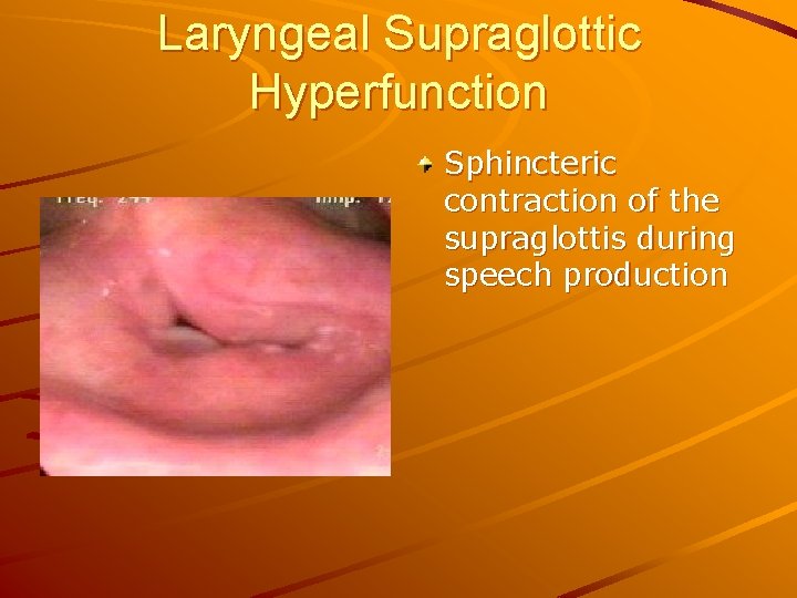Laryngeal Supraglottic Hyperfunction Sphincteric contraction of the supraglottis during speech production 