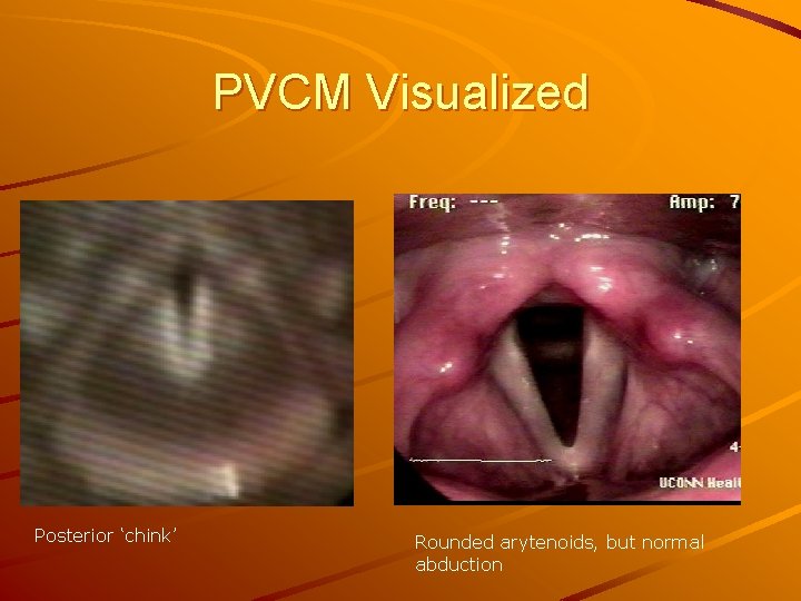 PVCM Visualized Posterior ‘chink’ Rounded arytenoids, but normal abduction 