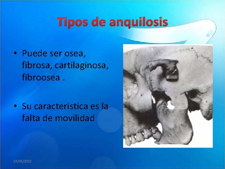 Tipos de anquilosis • Puede ser osea, fibrosa, cartilaginosa, fibroosea. • Su caracteristica es