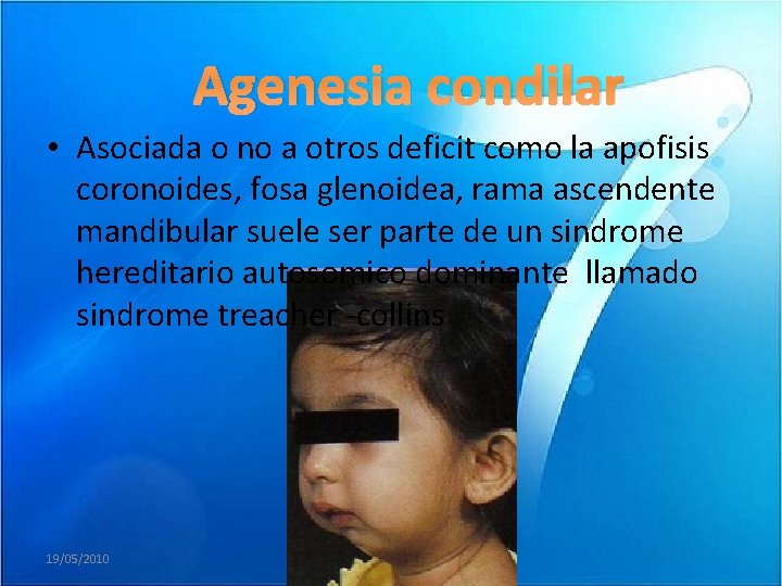 Agenesia condilar • Asociada o no a otros deficit como la apofisis coronoides, fosa