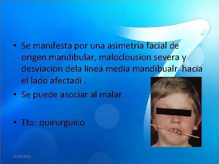  • Se manifesta por una asimetria facial de origen mandibular, maloclousion severa y