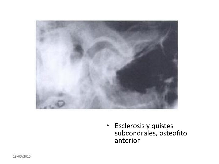  • Esclerosis y quistes subcondrales, osteofito anterior 19/05/2010 