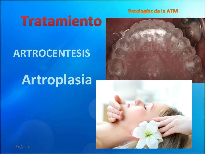 Tratamiento ARTROCENTESIS Artroplasia 19/05/2010 
