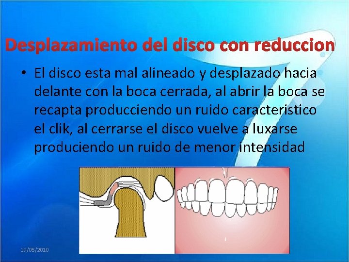 Desplazamiento del disco con reduccion • El disco esta mal alineado y desplazado hacia