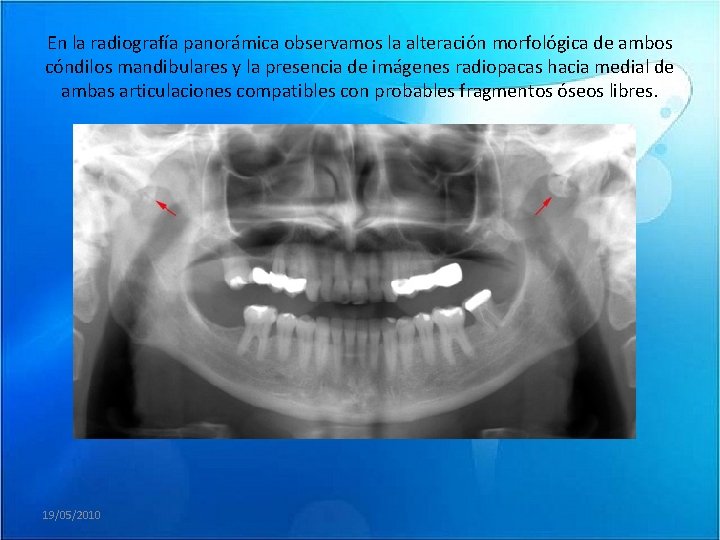 En la radiografía panorámica observamos la alteración morfológica de ambos cóndilos mandibulares y la