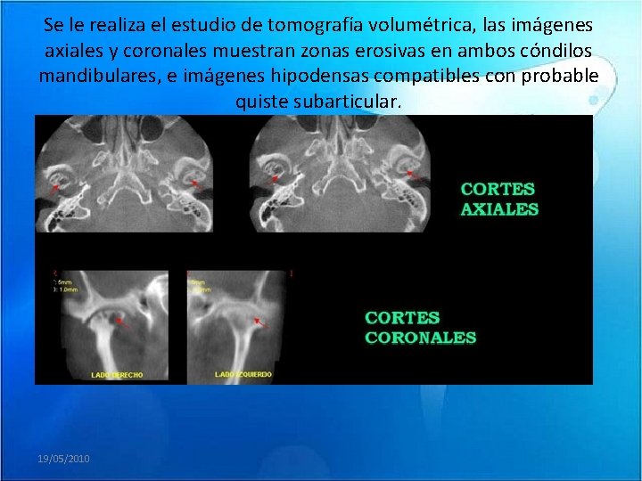 Se le realiza el estudio de tomografía volumétrica, las imágenes axiales y coronales muestran