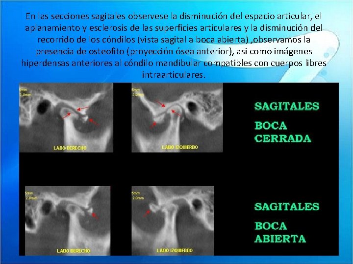 En las secciones sagitales observese la disminución del espacio articular, el aplanamiento y esclerosis