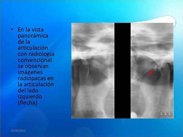  • En la vista panorámica de la articulación con radiologia convencional se observan