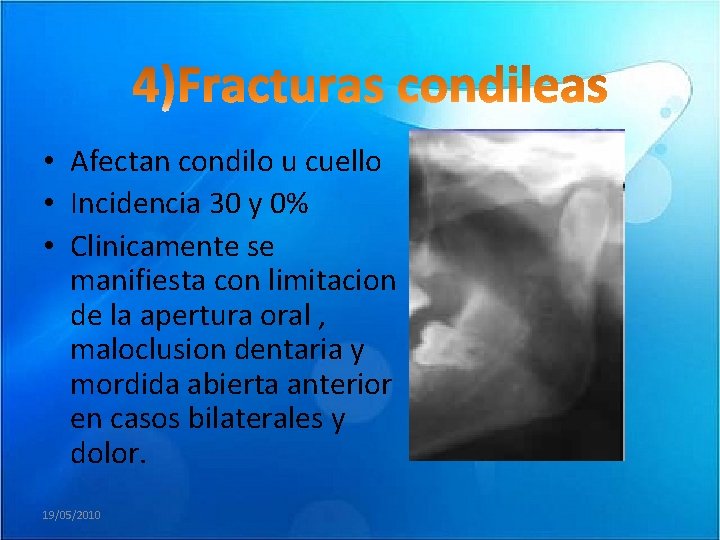  • Afectan condilo u cuello • Incidencia 30 y 0% • Clinicamente se