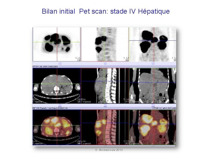 Bilan initial Pet scan: stade IV Hépatique FDG initial D. Bordessoule 2013 Bilan initial Pet scan: stade IV Hépatique FDG initial D. Bordessoule 2013