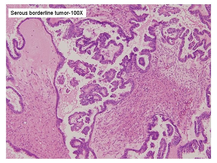 Serous borderline tumor-100 X 